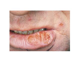 Cut In Corner Of Mouth, Angular Chelitis, Angular Cheilitis Pictures, Angular Cheilitis Vitamin