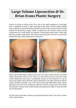 Large Volume Liposuction @ Dr. Brian Evans Plastic Surgery