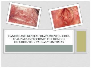 Candidiasis Genital Tratamiento – Cura Real para Infecciones por Hongos Recurrentes – Causas y Sintomas