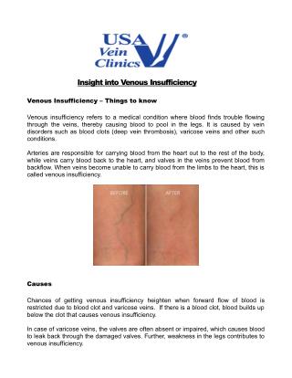 Insight into Venous Insufficiency - USA Vein Clinics