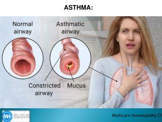 Best homeopathy for treating ASTHMA.