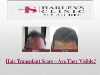 Hair Transplant Scars – Are They Visible?