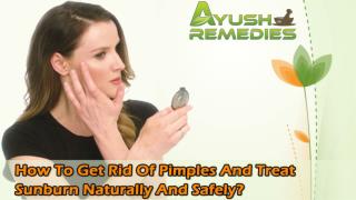 How To Get Rid Of Pimples And Treat Sunburn Naturally And Safely?