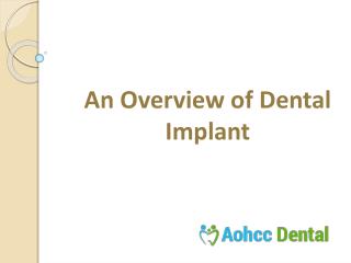 An Overview of Dental Implants