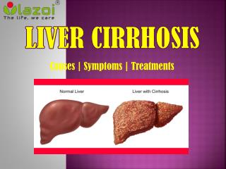 Cirrhosis of the Liver: A critical health condition.