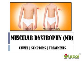 Muscular dystrophy: Group of more than 30 inherited diseases.