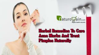 Herbal Remedies To Cure Acne Marks And Treat Pimples Naturally