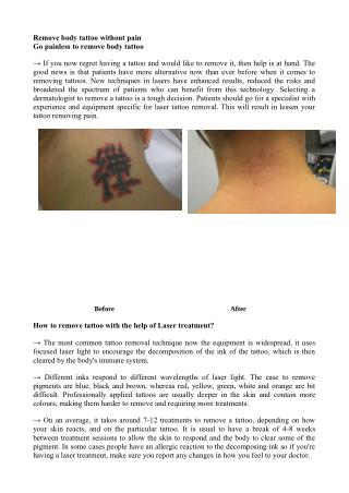 Remove Body Tattoo - unwantedtattoos.co.uk