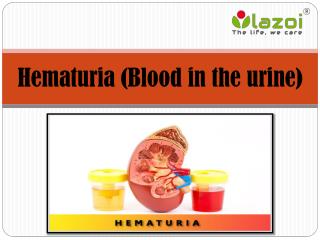 Hematuria or Blood In The Urine: Causes, Diagnosis and 