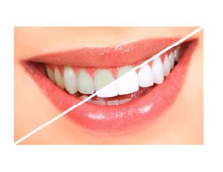 How To Make Your Teeth Whiter, Whiten Your Teeth At Home, Home Teeth Whitening Remedies