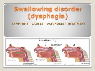 Swallowing disorder (dysphagia) in children- Causes, Symptoms, Diagnosis and Treatment