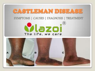 Castleman Disease : Symptoms, causes, diagnosis and treatment