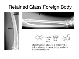 Retained Glass Foreign Body