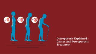 Osteoporosis Explained - Causes And Osteoporosis Treatment