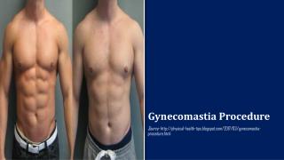 Gynecomastia Procedure