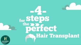 4 Steps For The Perfect Hair Transplant