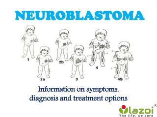 Neuroblastoma: symptoms, diagnosis and treatment options