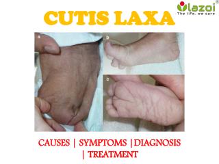 Cutis Laxa : Causes, symptoms, diagnosis, treatment and prevention