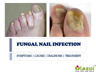 Fungal Nail Infection: causes, symptoms, diagnosis and treatment