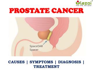Prostate Cancer: Information on symptoms, treatment and more