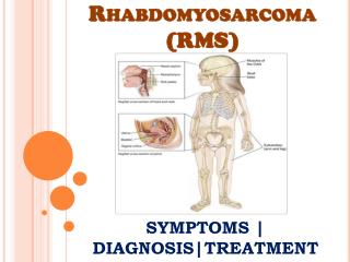 Rhabdomyosarcoma (RMS): Information on symptoms, diagnosis and treatment
