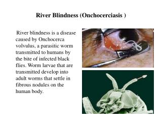 Stromectol: Boost for Fight to Rid of River Blindness