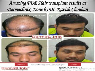 Best Hair Transplant in Delhi