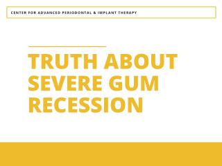 Truth about Severe Gum Recession