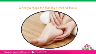 3 Simple steps for healing Cracked Heels