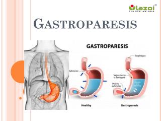 Gastroparesis: Causes, Symptoms, Diagnosis and Treatment