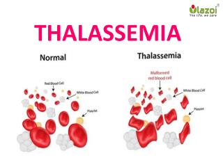 Thalessemia : Overview, Symptoms, complications, Risk factor, Causes, Daignosis and Treatment