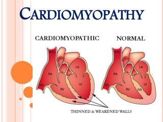 Heart Muscle Disease (Cardiomyopathy)
