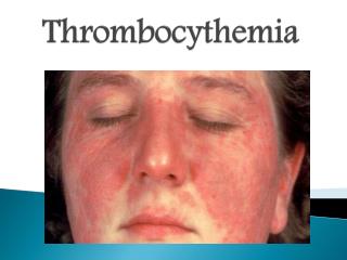 Thrombocythemia: Causes, Symptoms, Diagnosis, and Treatment