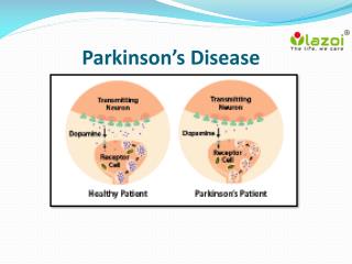 Parkinson’s Disease : overview, symptoms, causes, treatment and diagnosis