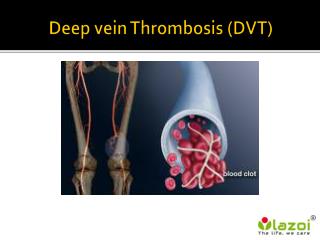 PPT - DEEP VEIN THROMBOSIS PowerPoint Presentation - ID:5393294