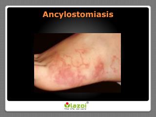 Ancylostomiasis - Symptoms, Treatments and Preventions
