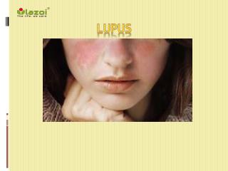 Lupus: Symptoms, Causes, Diagnosis and Treatment