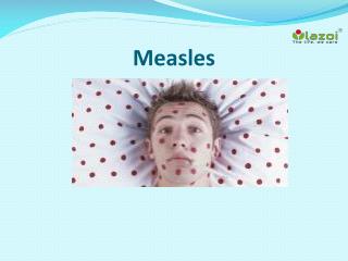 Measles: Causes, Symptoms, Complications and Treatment