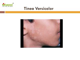 Tinea Versicolor: Symptoms, Causes, Diagnosis and Treatment