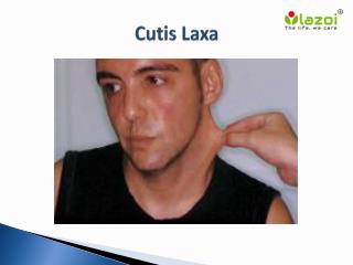 Cutis Laxa: Causes, Symptoms, Diagnosis and Treatment