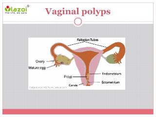 vaginal skin tags inside vagina