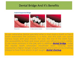 Dental Bridge And It's Benefits