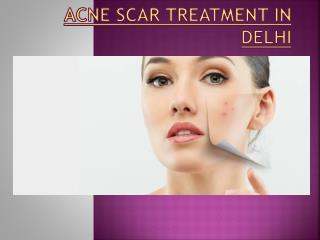 acne scar removal treatment in delhi