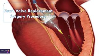 Heart Valve Replacement Surgery Procedure