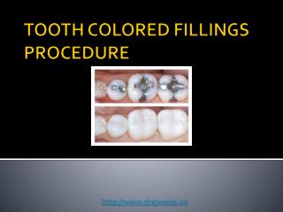 Overview of Tooth Colored Fillings Procedure by Pune’s Best Dentist – Dr Ajwani