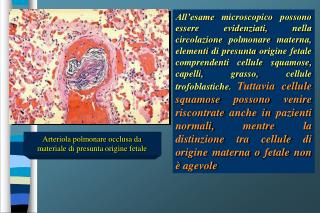 Arteriola polmonare occlusa da materiale di presunta origine fetale