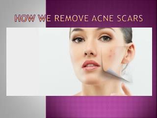 How we remove acne scars