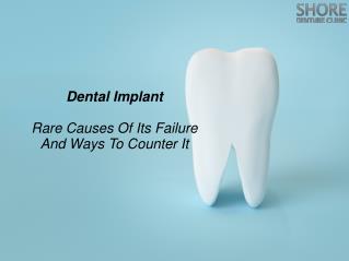 Dental Implant: Rare Causes Of Its Failure And Ways To Counter It