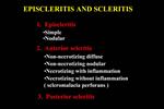 EPISCLERITIS AND SCLERITIS
