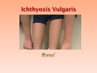 Ichthyosis Vulgaris: Symptoms, Causes, Diagnosis and Treatment